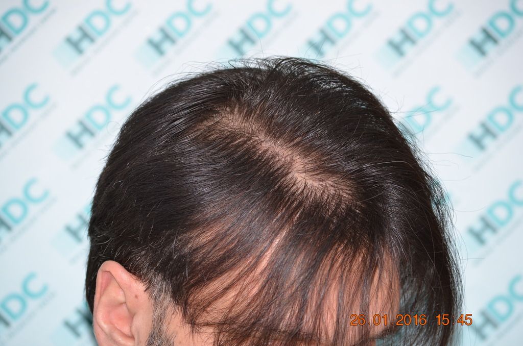 17-%2018%20months%20post%20op%20hairs%20parted_zps4qhtj3dl.jpg