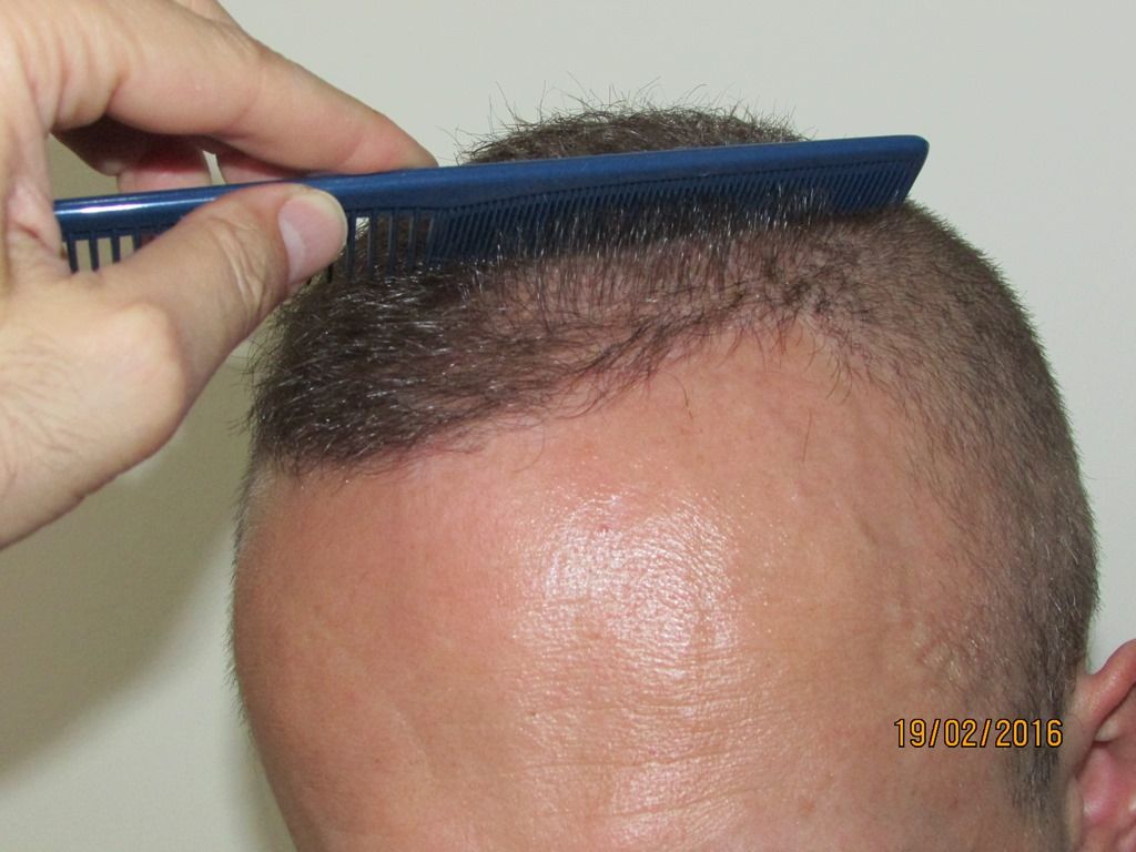 14-%2016%20months%20after%203rd%20with%20comb_zps9dpim6st.jpg