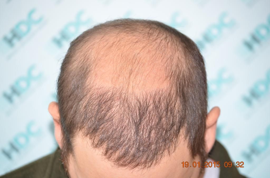 10-%208%20months%20and%20before%202nd%20procedure%20front_zpspyta8wwe.jpg