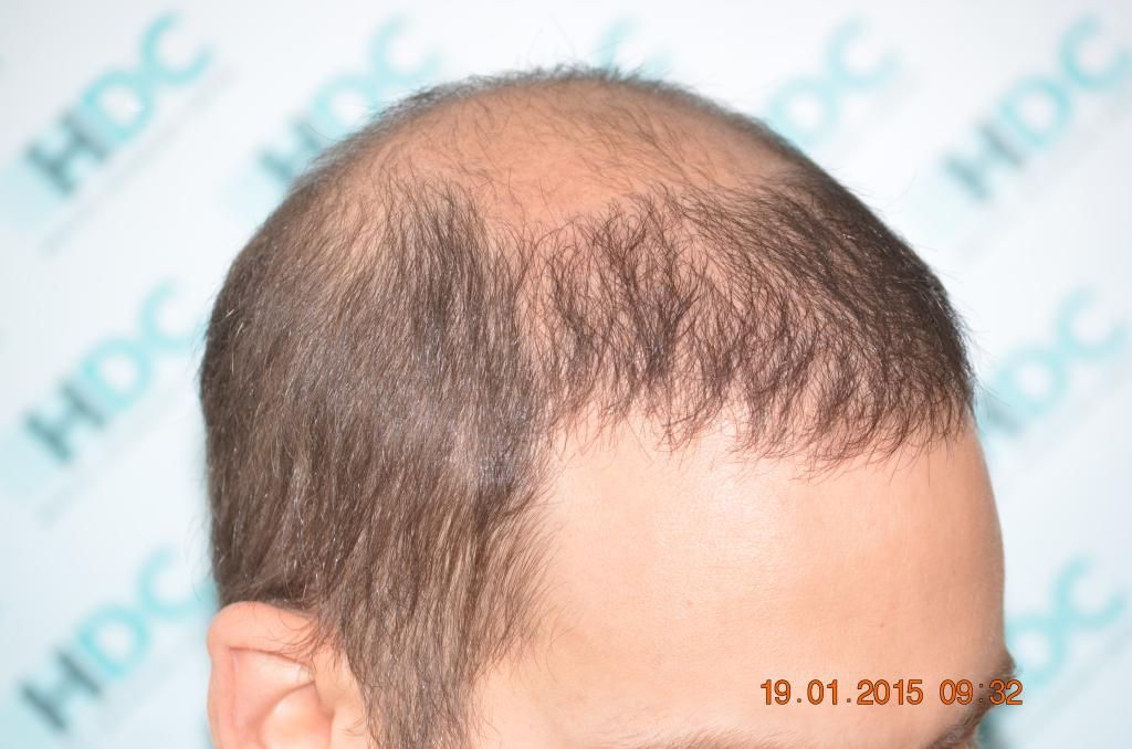 11-%208%20months%20and%20before%202nd%20procedure%20right%20side_zpsm076lhjd.jpg