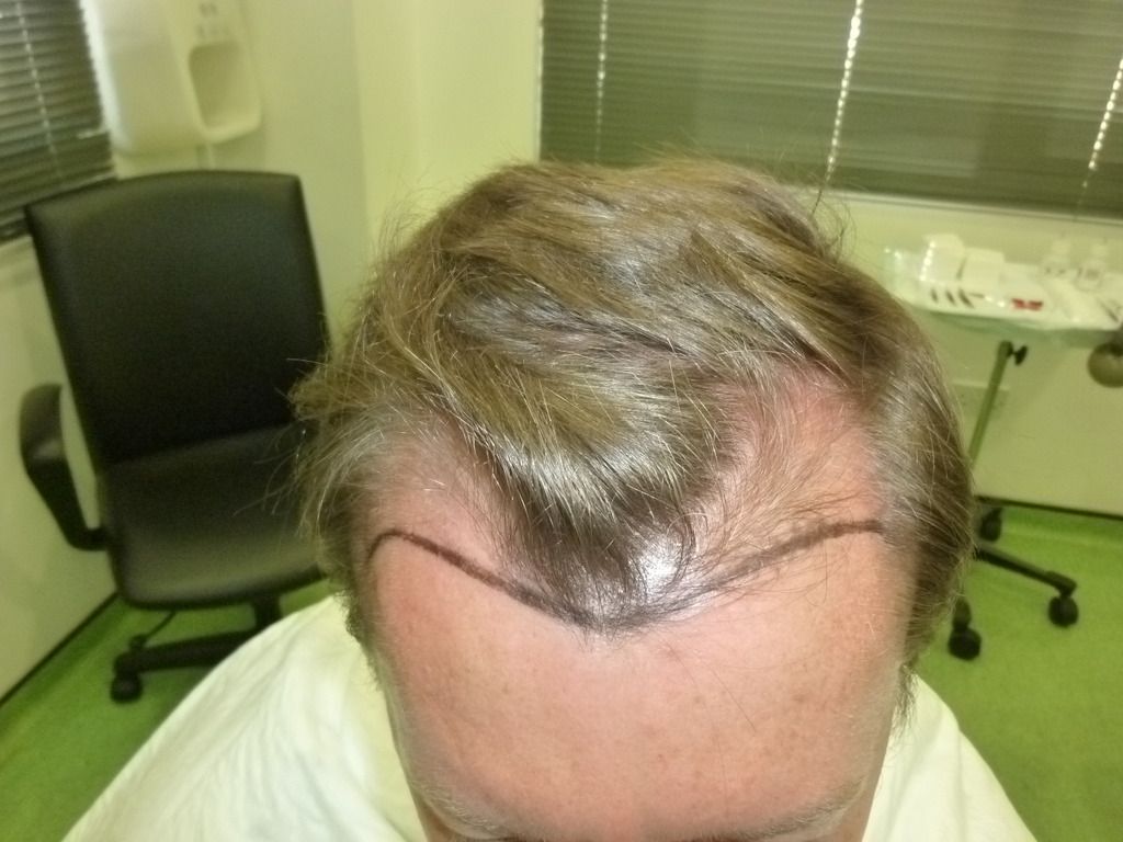 3-Hairline%20design%20on%20the%20surgery%20day_zps7wmiqklw.jpg