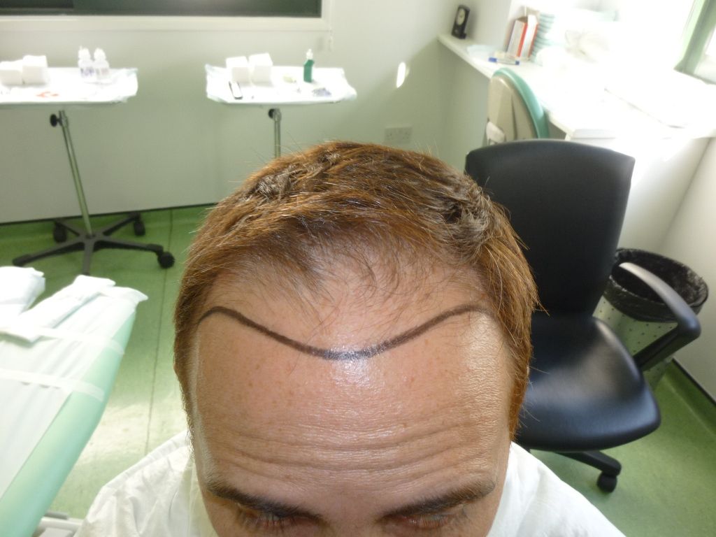 4-%20Hairline%20design%20front_zps2v2c60dr.jpg