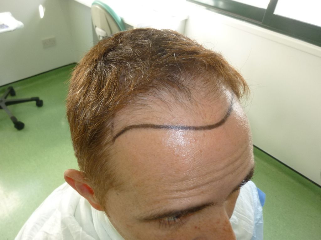 5-%20Hairline%20design%20right%20side_zpss0j0dbc5.jpg