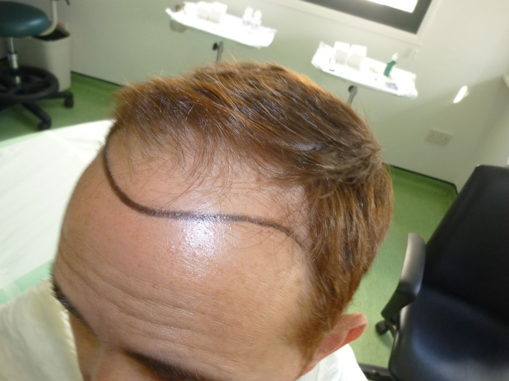 6-%20Hairline%20design%20left%20side_zps8ivf8idm.jpg