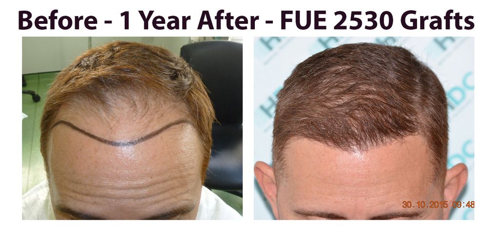 Before%20and%20After%202530%20grafts_zpsotgb6brb.jpg