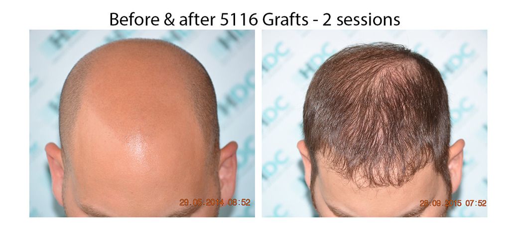 9-Before%20and%20after%205116%20grafts_zps7tizmwnn.jpg