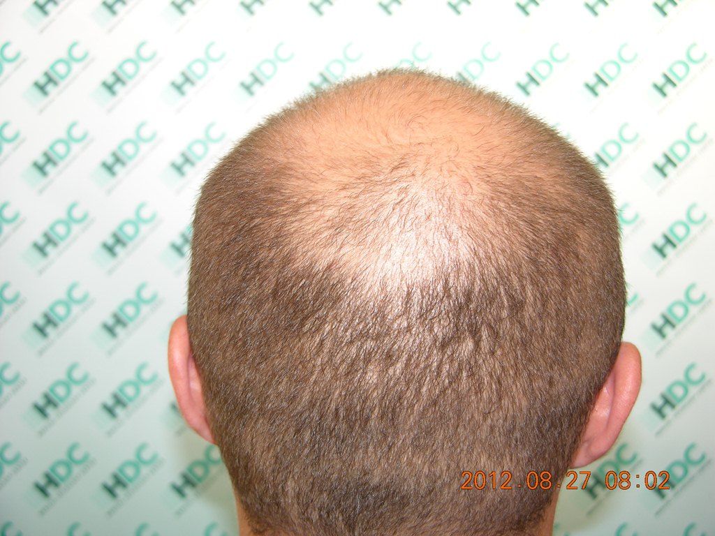 DonorBefore3000grafts_zps199e47d6.jpg