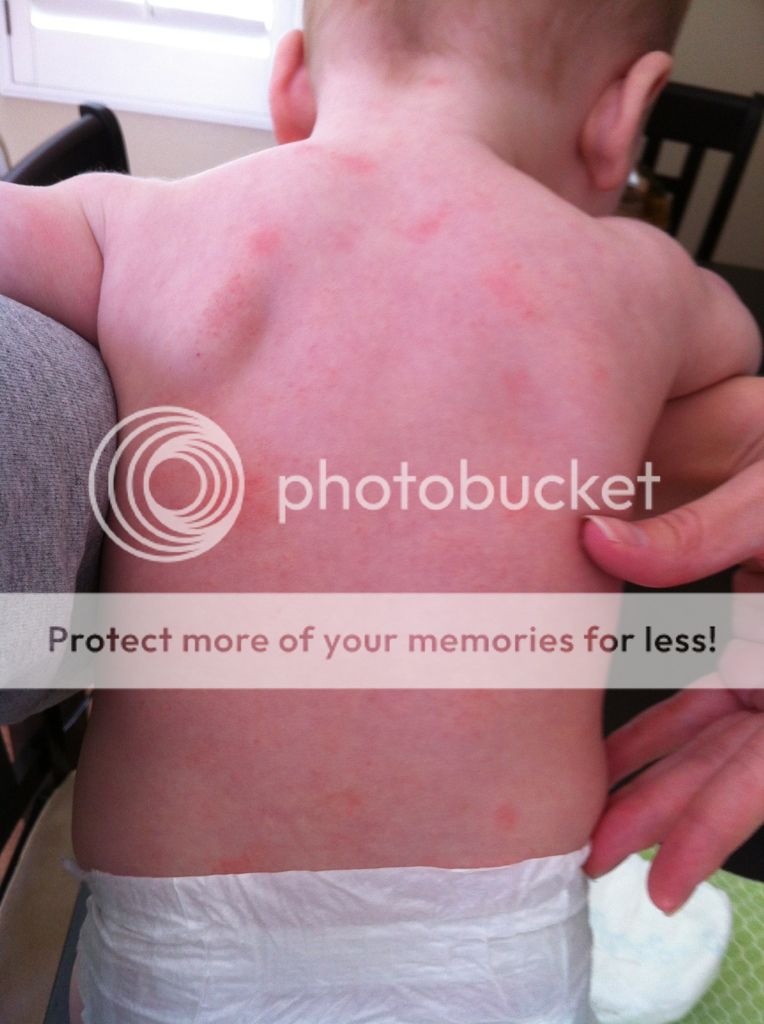 Does this look like heat rash? (pic) BabyCenter